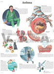 Asthma - Anatomical Chart